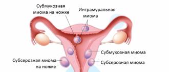 Особенности течения рака шейки матки второй стадии